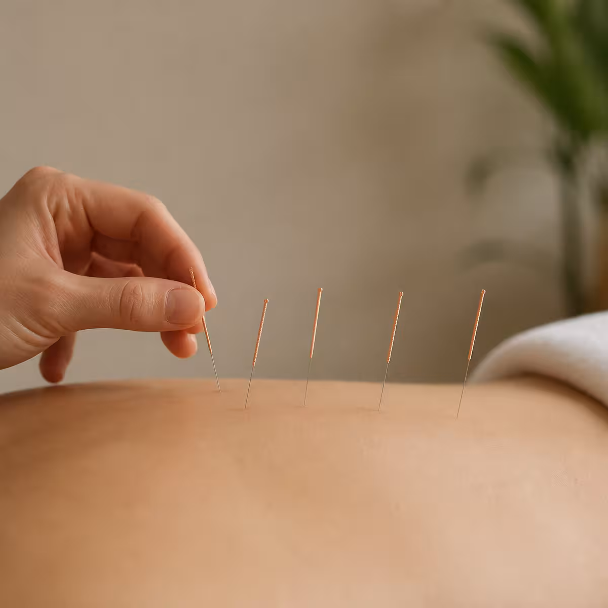 Acupunctură